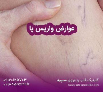 عوارض واریس پا