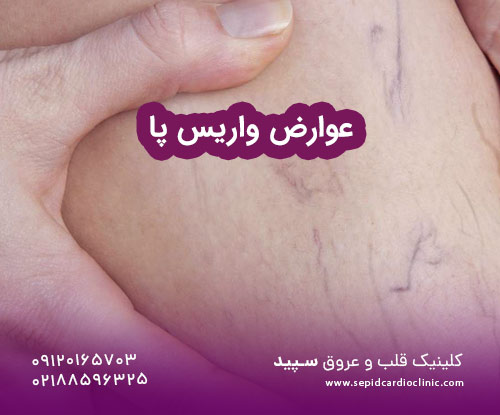 عوارض واریس پا