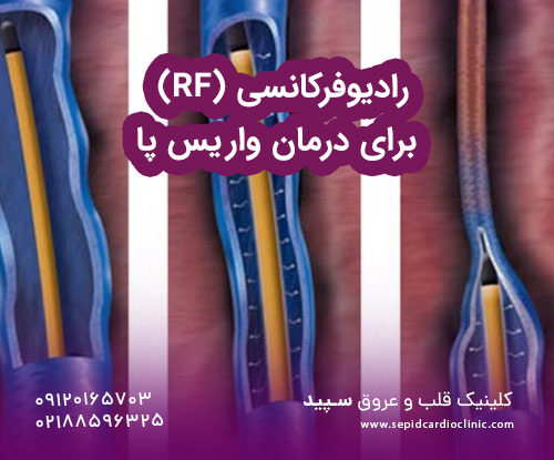 رادیوفرکانسی (RF) برای درمان واریس پا