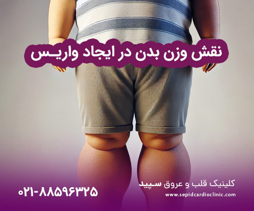 نقش وزن بدن در ایجاد واریس