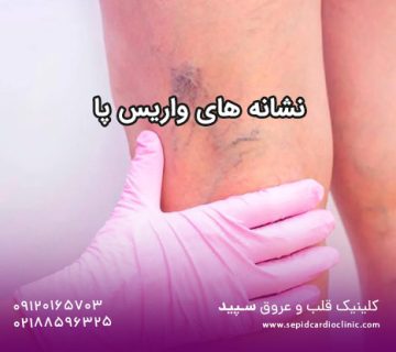 نشانه های واریس پا