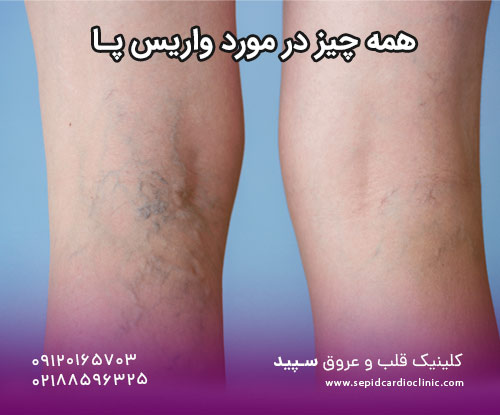 همه چیز در مورد واریس پا