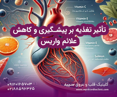 تأثیر تغذیه بر پیشگیری و کاهش علائم واریس