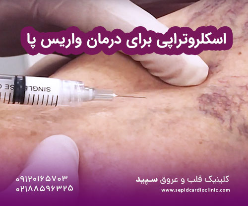 اسکلروتراپی برای درمان واریس پا