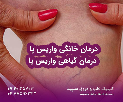 درمان خانگی واریس پا | درمان گیاهی واریس پا