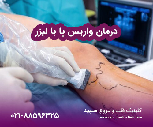 درمان واریس پا با لیزر