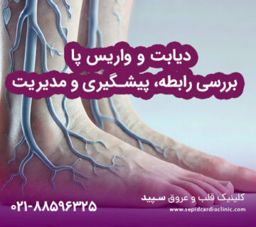 دیابت و واریس پا و بررسی رابطه، پیشگیری و مدیریت